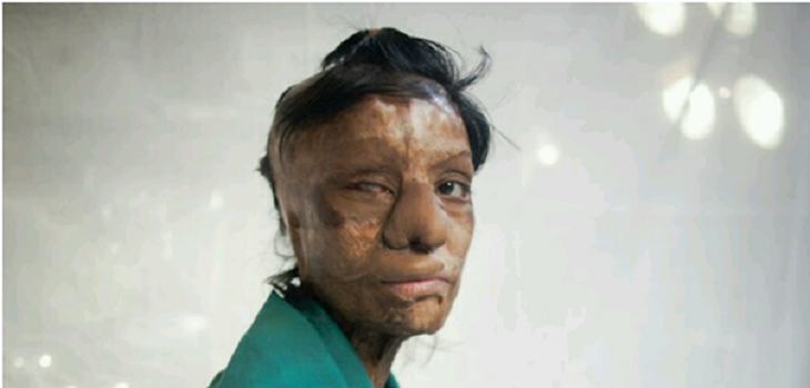 acid attack changed her life